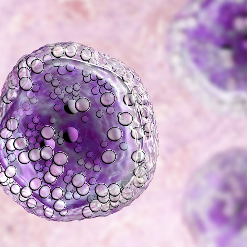 understanding your lymphoma Burkitt's Lymphoma Cell